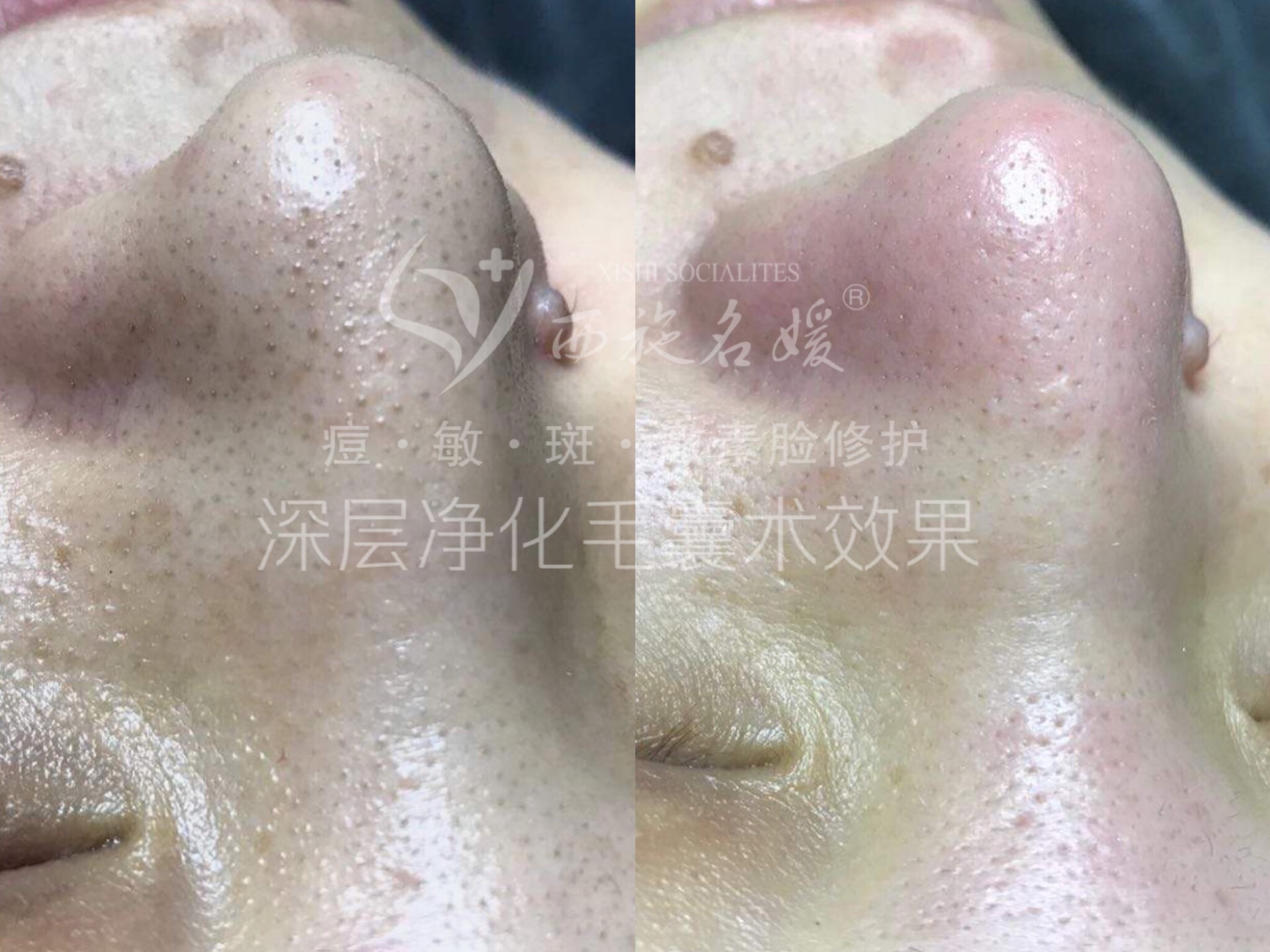厲害了，我用【毛囊清潔術】促成了一段姻緣...