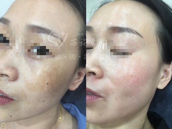 真的能行！不提取，不剝脫，涂抹就下“斑”