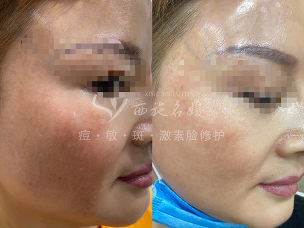 真的能行！不提取，不剝脫，涂抹就下“斑”